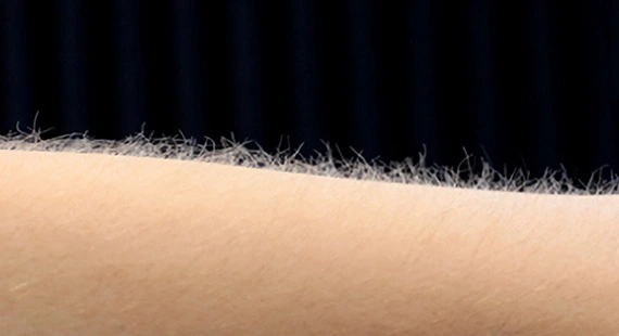 what is unwanted hair 